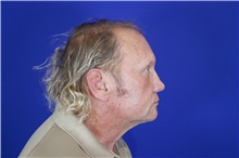 Eyelid Surgery After Photo by Thanapoom Boonipat, MD; Lubbock, TX - Case 51556