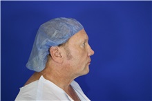 Eyelid Surgery Before Photo by Thanapoom Boonipat, MD; Lubbock, TX - Case 51556