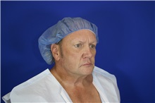 Eyelid Surgery Before Photo by Thanapoom Boonipat, MD; Lubbock, TX - Case 51554