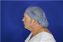 Eyelid Surgery Before Photo by Thanapoom Boonipat, MD; Lubbock, TX - Case 51557