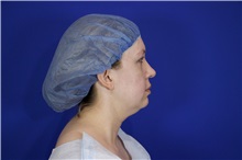 Liposuction Before Photo by Thanapoom Boonipat, MD; Lubbock, TX - Case 51558