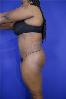 Tummy Tuck After Photo by Thanapoom Boonipat, MD; Lubbock, TX - Case 51573