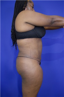 Tummy Tuck After Photo by Thanapoom Boonipat, MD; Lubbock, TX - Case 51572