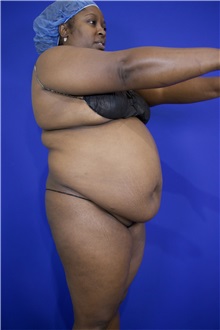 Tummy Tuck Before Photo by Thanapoom Boonipat, MD; Lubbock, TX - Case 51572