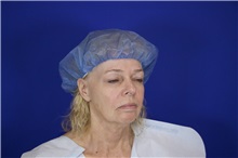 Facelift Before Photo by Thanapoom Boonipat, MD; Lubbock, TX - Case 51568