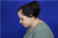Facelift After Photo by Thanapoom Boonipat, MD; Lubbock, TX - Case 51559
