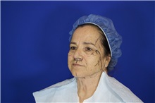 Facelift Before Photo by Thanapoom Boonipat, MD; Lubbock, TX - Case 51559