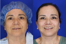Facelift After Photo by Thanapoom Boonipat, MD; Lubbock, TX - Case 51560
