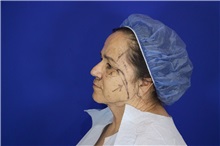 Facelift Before Photo by Thanapoom Boonipat, MD; Lubbock, TX - Case 51560