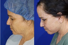 Facelift After Photo by Thanapoom Boonipat, MD; Lubbock, TX - Case 51562