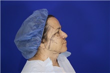 Facelift Before Photo by Thanapoom Boonipat, MD; Lubbock, TX - Case 51562