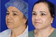 Facelift After Photo by Thanapoom Boonipat, MD; Lubbock, TX - Case 51561