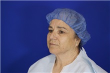 Facelift Before Photo by Thanapoom Boonipat, MD; Lubbock, TX - Case 51561