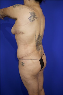 Breast Lift After Photo by Thanapoom Boonipat, MD; Lubbock, TX - Case 51582