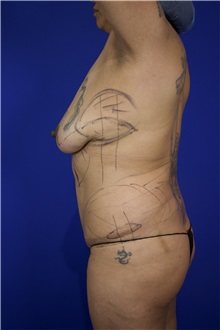 Breast Lift Before Photo by Thanapoom Boonipat, MD; Lubbock, TX - Case 51582