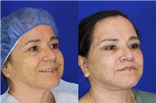 Facelift After Photo by Thanapoom Boonipat, MD; Lubbock, TX - Case 51564