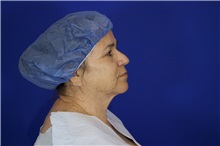 Facelift Before Photo by Thanapoom Boonipat, MD; Lubbock, TX - Case 51564