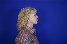 Facelift After Photo by Thanapoom Boonipat, MD; Lubbock, TX - Case 51566