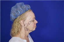 Facelift Before Photo by Thanapoom Boonipat, MD; Lubbock, TX - Case 51566