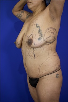 Breast Lift Before Photo by Thanapoom Boonipat, MD; Lubbock, TX - Case 51581