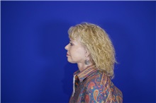 Facelift After Photo by Thanapoom Boonipat, MD; Lubbock, TX - Case 51567