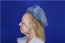 Facelift Before Photo by Thanapoom Boonipat, MD; Lubbock, TX - Case 51567
