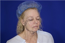 Facelift Before Photo by Thanapoom Boonipat, MD; Lubbock, TX - Case 51565