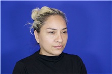 Facelift After Photo by Thanapoom Boonipat, MD; Lubbock, TX - Case 51575