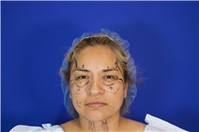 Facelift Before Photo by Thanapoom Boonipat, MD; Lubbock, TX - Case 51575