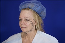 Facelift Before Photo by Thanapoom Boonipat, MD; Lubbock, TX - Case 51569
