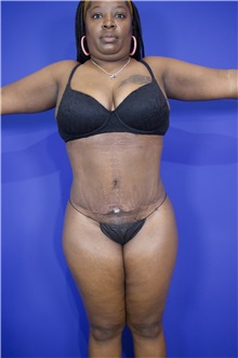 Tummy Tuck After Photo by Thanapoom Boonipat, MD; Lubbock, TX - Case 51570