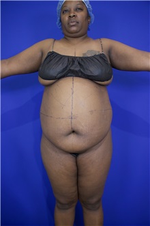 Tummy Tuck Before Photo by Thanapoom Boonipat, MD; Lubbock, TX - Case 51570