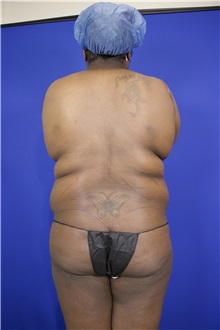Tummy Tuck Before Photo by Thanapoom Boonipat, MD; Lubbock, TX - Case 51571