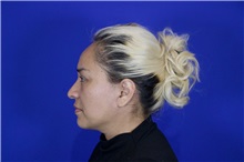 Facelift After Photo by Thanapoom Boonipat, MD; Lubbock, TX - Case 51578
