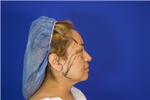 Facelift Before Photo by Thanapoom Boonipat, MD; Lubbock, TX - Case 51578