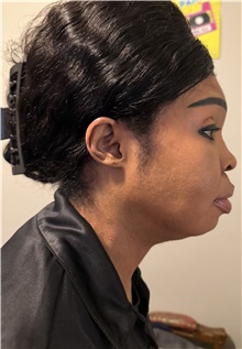 Chin Augmentation Before Photo by Thanapoom Boonipat, MD; Lubbock, TX - Case 51579