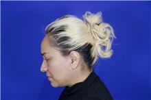 Facelift After Photo by Thanapoom Boonipat, MD; Lubbock, TX - Case 51576