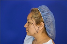 Facelift Before Photo by Thanapoom Boonipat, MD; Lubbock, TX - Case 51576