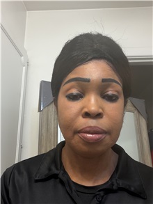 Chin Augmentation Before Photo by Thanapoom Boonipat, MD; Lubbock, TX - Case 51574