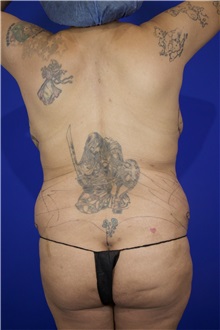 Breast Lift Before Photo by Thanapoom Boonipat, MD; Lubbock, TX - Case 51583