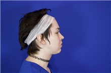 Facial Feminization After Photo by Thanapoom Boonipat, MD; Lubbock, TX - Case 51585