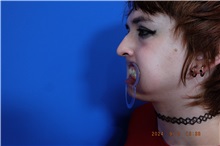 Facial Feminization Before Photo by Thanapoom Boonipat, MD; Lubbock, TX - Case 51585