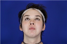 Facial Feminization After Photo by Thanapoom Boonipat, MD; Lubbock, TX - Case 51584