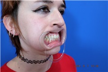 Facial Feminization Before Photo by Thanapoom Boonipat, MD; Lubbock, TX - Case 51584