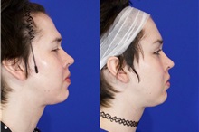 Facial Feminization After Photo by Thanapoom Boonipat, MD; Lubbock, TX - Case 51587