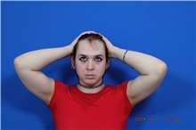 Facial Feminization Before Photo by Thanapoom Boonipat, MD; Lubbock, TX - Case 51587