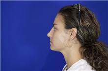 Rhinoplasty After Photo by Thanapoom Boonipat, MD; Lubbock, TX - Case 51591