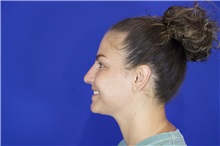 Rhinoplasty Before Photo by Thanapoom Boonipat, MD; Lubbock, TX - Case 51591