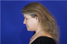 Facelift After Photo by Thanapoom Boonipat, MD; Lubbock, TX - Case 51590