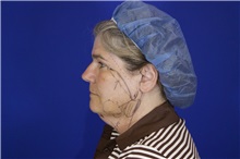 Facelift Before Photo by Thanapoom Boonipat, MD; Lubbock, TX - Case 51590